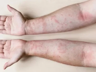 Kiat Mengatasi Alergi dan Mencegah Komplikasi Penyakit